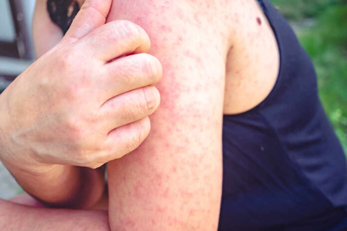 Viral,Skin,Disease,Measles,Rash,Women,With,Dermatitis,Of,Itching