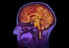 Human brain MRI side profile with colorful scan overlay